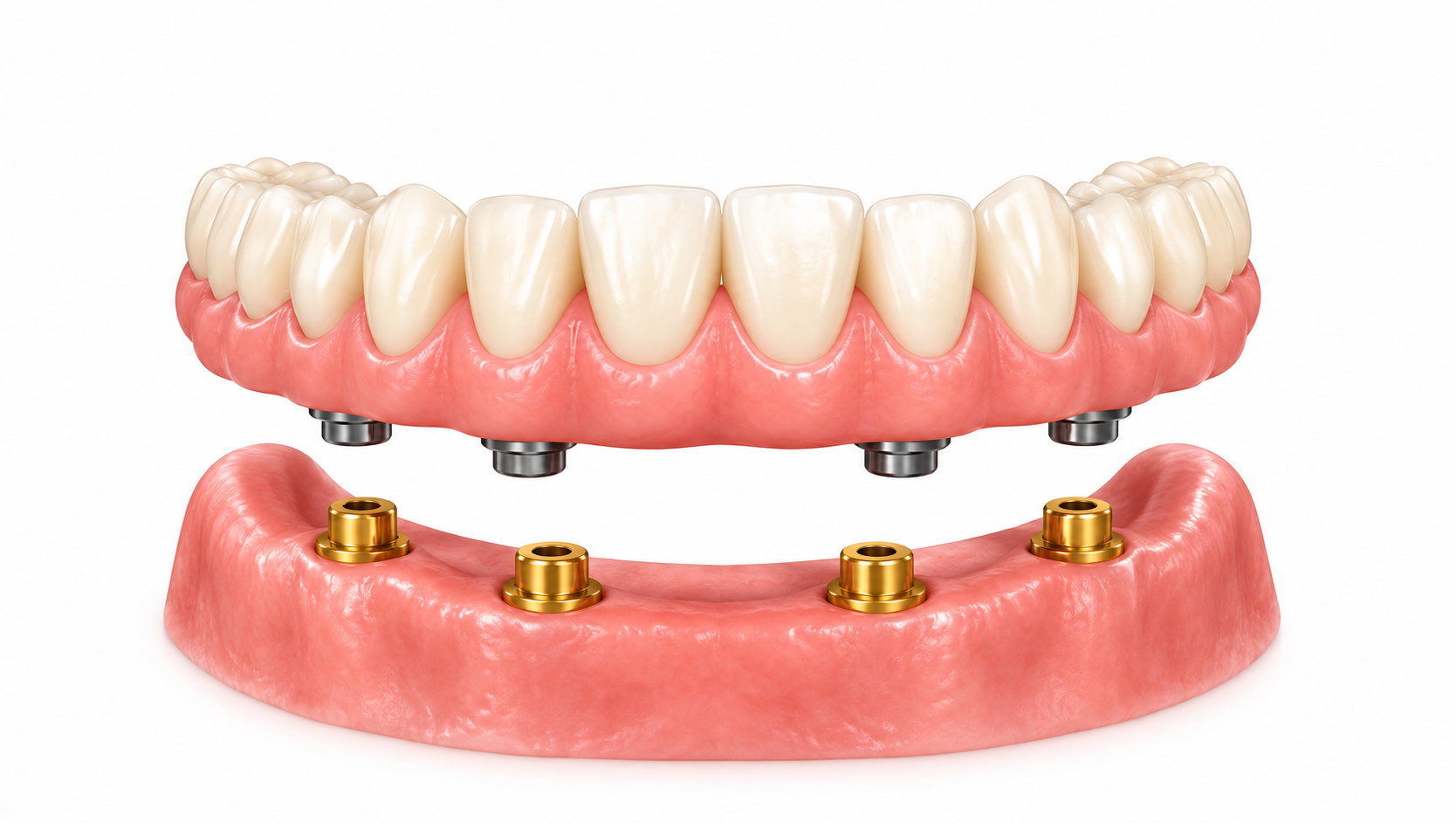 Fixed detachable hybrid dentures